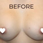 Breast Augmentation (Revision) Before & After Patient #591