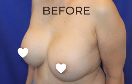 Breast Augmentation (Revision) Before & After Patient #590