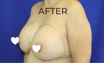 Breast Augmentation (Revision) Before & After Patient #590