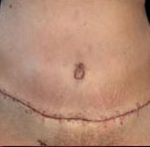 Tummy Tuck Before & After Patient #729