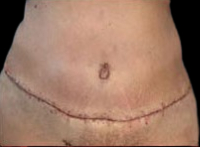 Tummy Tuck Before & After Patient #729