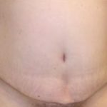 Tummy Tuck Before & After Patient #737