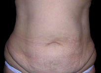 Tummy Tuck Before & After Patient #732