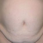 Tummy Tuck Before & After Patient #737