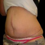 Tummy Tuck Before & After Patient #731