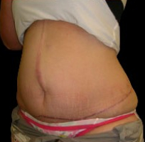 Tummy Tuck Before & After Patient #731