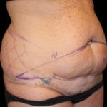 Tummy Tuck Before & After Patient #730