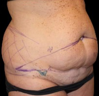 Tummy Tuck Before & After Patient #730
