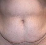 Tummy Tuck Before & After Patient #729