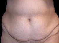 Tummy Tuck Before & After Patient #729