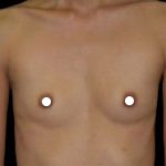 Breast Augmentation (Saline) Before & After Patient #473