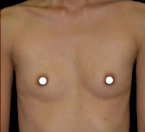 Breast Augmentation (Saline) Before & After Patient #473