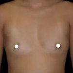 Breast Augmentation (Saline) Before & After Patient #475