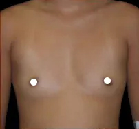Breast Augmentation (Saline) Before & After Patient #475