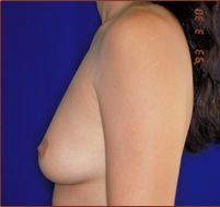 Breast Augmentation (Saline) Before & After Patient #467