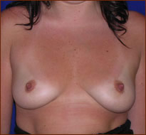 Breast Augmentation (Saline) Before & After Patient #469