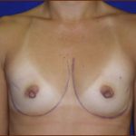 Breast Augmentation (Saline) Before & After Patient #470
