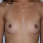 Breast Augmentation (Saline) Before & After Patient #472