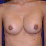 Breast Augmentation (Saline) Before & After Patient #473