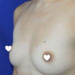 Breast Augmentation (Silicone) Before & After Patient #569