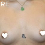 Breast Augmentation (Silicone) Before & After Patient #570