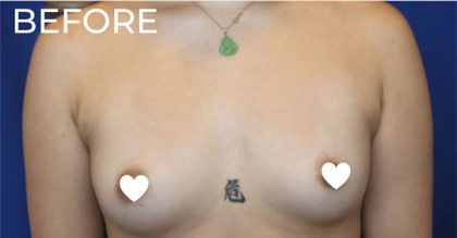 Breast Augmentation (Silicone) Before & After Patient #570
