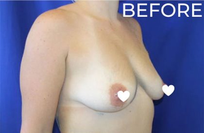 Breast Augmentation (Silicone) Before & After Patient #571