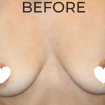 Breast Augmentation (Silicone) Before & After Patient #572