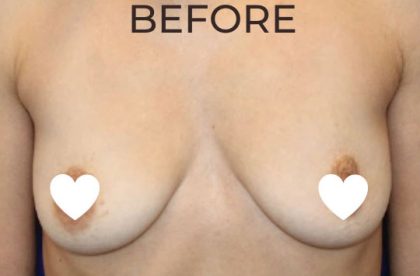 Breast Augmentation (Silicone) Before & After Patient #572
