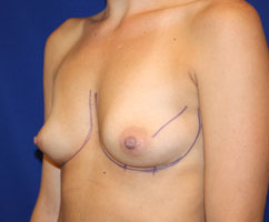 Breast Augmentation (Silicone) Before & After Patient #573