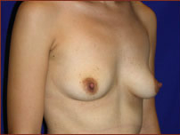 Breast Augmentation (Silicone) Before & After Patient #576