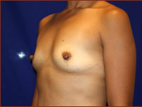 Breast Augmentation (Silicone) Before & After Patient #577