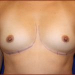 Breast Augmentation (Silicone) Before & After Patient #578