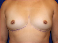 Breast Augmentation (Silicone) Before & After Patient #578