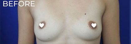 Breast Augmentation (Silicone) Before & After Patient #560