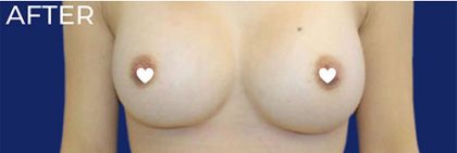 Breast Augmentation (Silicone) Before & After Patient #560
