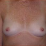 Breast Augmentation (Silicone) Before & After Patient #579