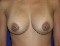 Breast Augmentation (Silicone) Before & After Patient #580