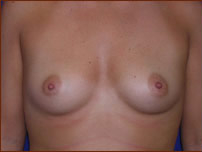 Breast Augmentation (Silicone) Before & After Patient #581