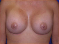Breast Augmentation (Silicone) Before & After Patient #581
