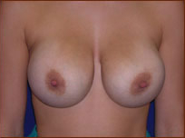 Breast Augmentation (Silicone) Before & After Patient #583