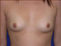 Breast Augmentation (Silicone) Before & After Patient #584