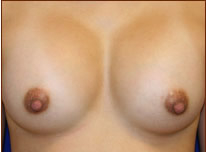 Breast Augmentation (Silicone) Before & After Patient #585