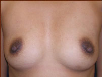 Breast Augmentation (Silicone) Before & After Patient #586