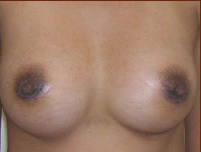 Breast Augmentation (Silicone) Before & After Patient #586