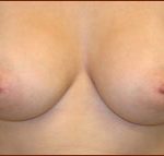 Breast Augmentation (Silicone) Before & After Patient #587