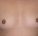 Breast Augmentation (Silicone) Before & After Patient #588