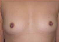 Breast Augmentation (Silicone) Before & After Patient #588