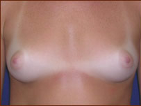Breast Augmentation (Silicone) Before & After Patient #589