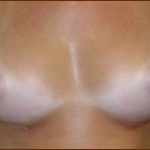 Breast Augmentation (Silicone) Before & After Patient #589